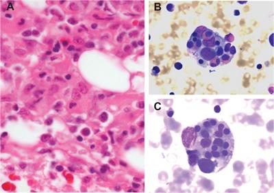 Hemophagocytic lymphohistiocytosis as an etiology of bone marrow failure